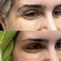 All You Need to Know About Crow's Feet: From Botox to Alternatives