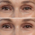 Fillers: A Comprehensive Guide to Non-Invasive Botox Alternatives