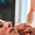 The Benefits of Acupuncture for Anti-Aging and Cosmetic Procedures