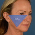 Understanding Facelift Procedures