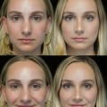 Everything You Need to Know About Rhinoplasty: A Comprehensive Guide