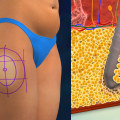 Understanding Liposuction: A Complete Guide for Anti-Aging and Cosmetic Procedures