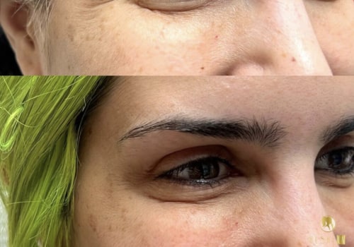 All You Need to Know About Crow's Feet: From Botox to Alternatives