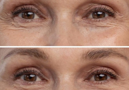 Fillers: A Comprehensive Guide to Non-Invasive Botox Alternatives