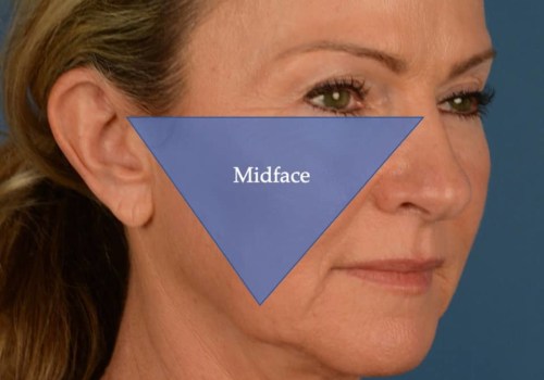Understanding Facelift Procedures