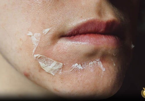 Exploring the Benefits and Risks of Chemical Peels for Youthful Skin