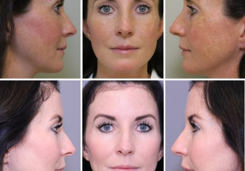 The Power of Laser Resurfacing: A Non-Invasive Alternative to Botox
