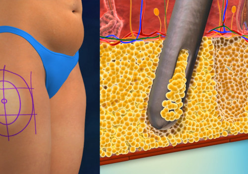Understanding Liposuction: A Complete Guide for Anti-Aging and Cosmetic Procedures