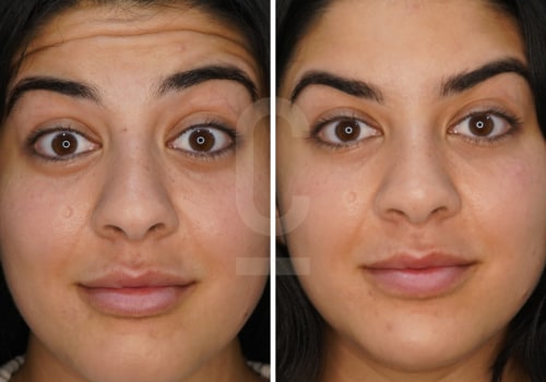 Exploring the World of Forehead Lines