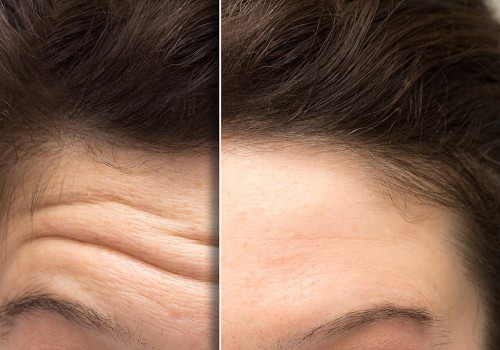 Topical Creams: An Alternative to Botox for Anti-Aging Treatment